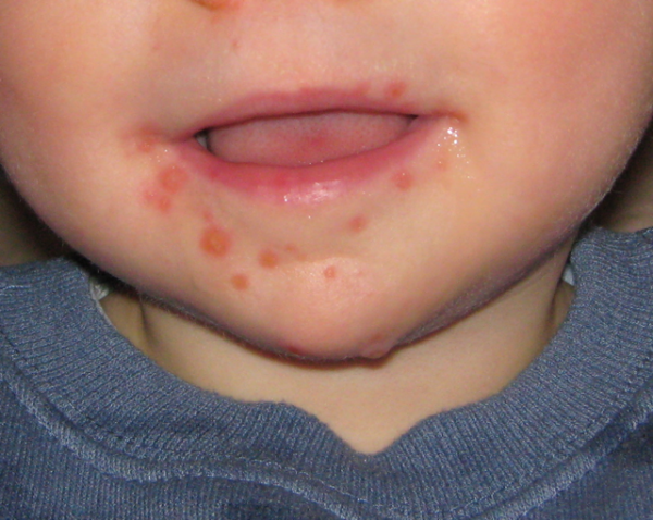Toddler with Hand Foot and Mouth Disease