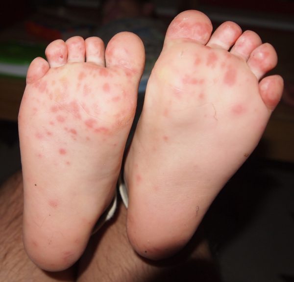 Hand foot and mouth disease on child's feet