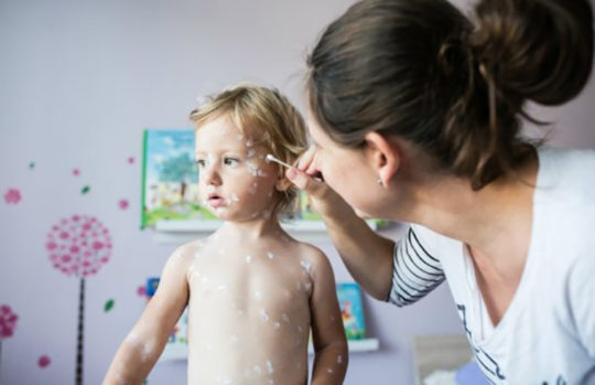 Toddler with chicken pox with mother - feature