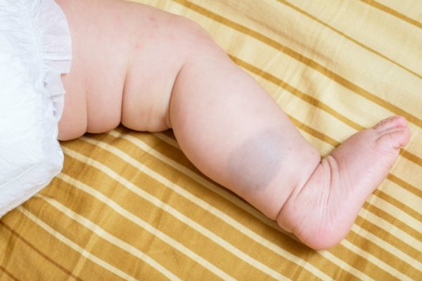 baby leg with birthmark