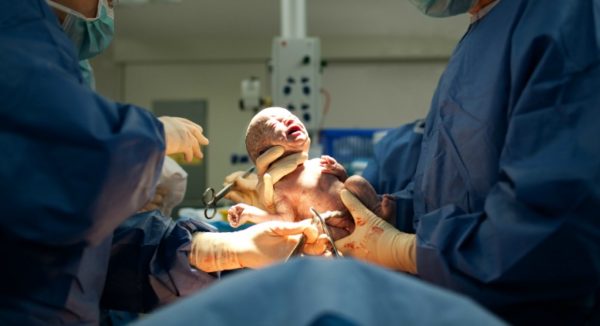 Baby being born caesarean