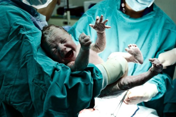 Baby born c-section