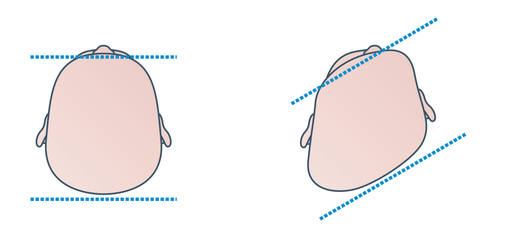 Plagiocephaly by The Royal Children’s Hospital