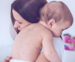 Baby in mother's arms with measles - feature