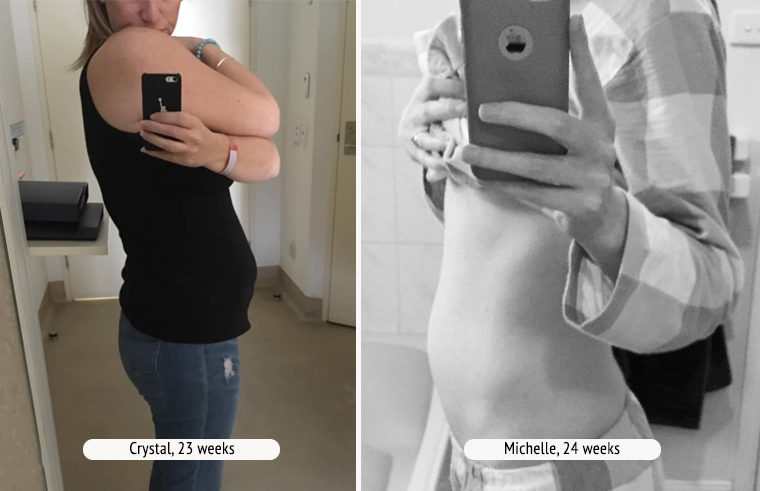 Comparison photo of two pregnant women at 24 weeks